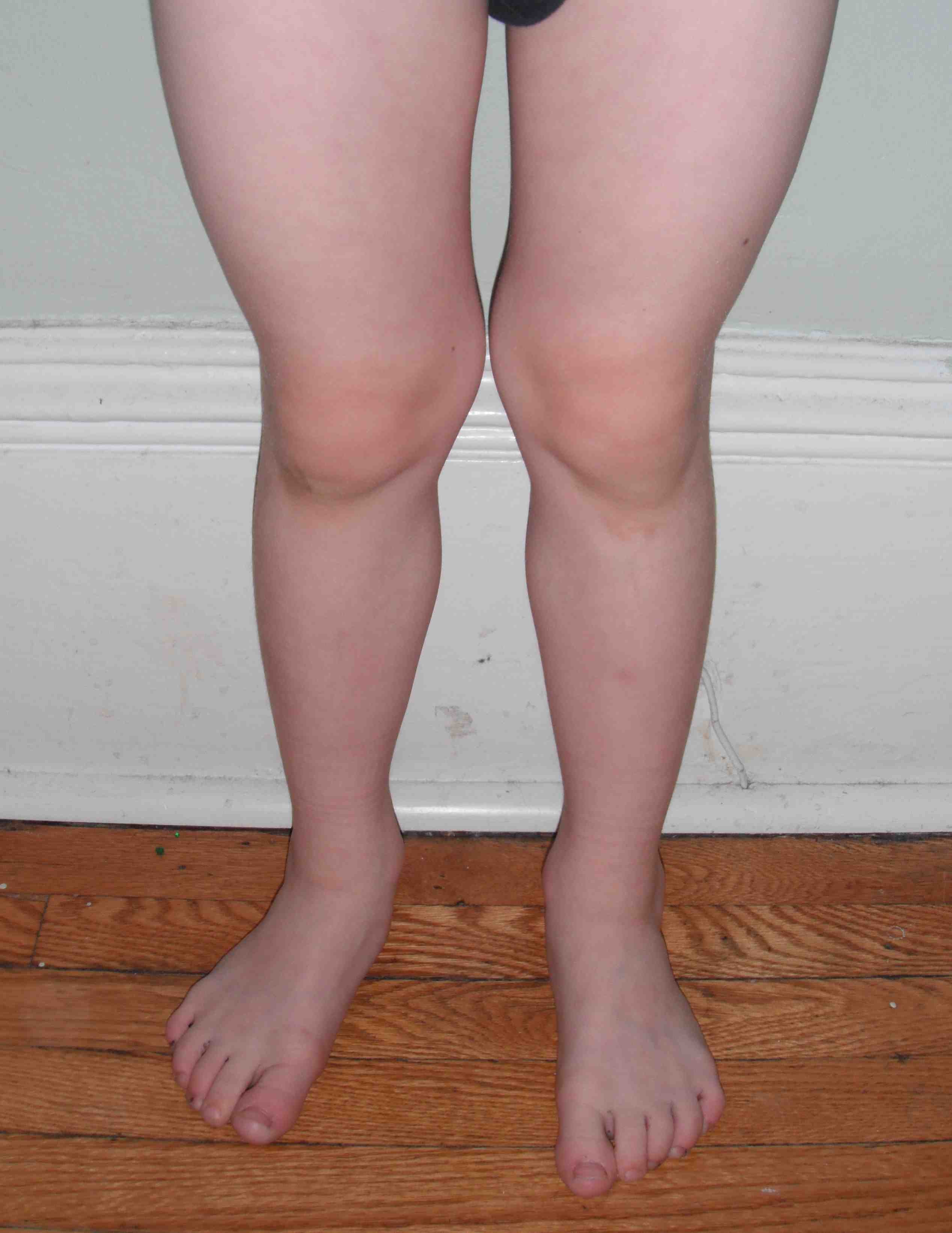 Normal valgus six year old